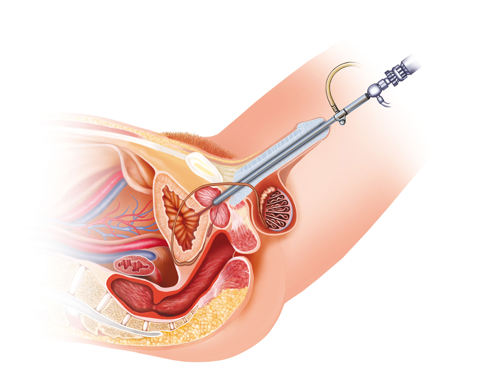 Best  Urethral Stricture Treatment  in Mumbai 